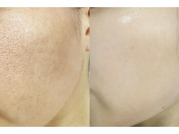 プラチナスタイル(platinum.style)/毛穴洗浄 before after