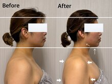 ベール(BEHL)/コルギのBefore After