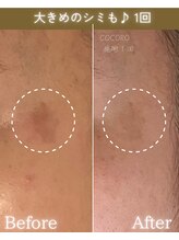 ココロ(COCORO)/大き目のシミケア　1回施術