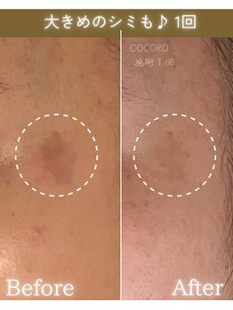 ココロ(COCORO)/大き目のシミケア 1回施術