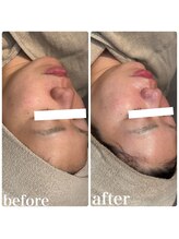 ディオーネ 春日井勝川店(Dione)/顔脱毛＋毛穴洗浄