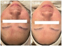 メゾンリュバン 天王寺(Maison Ruban)/お肌の色ムラ、肌トーンを均一に