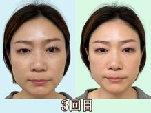 ナチュラルパーフェクトフェイス 新宿/3回目／ムクミ改善/新宿小顔矯正