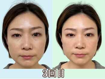 ナチュラルパーフェクトフェイス 新宿/3回目／ムクミ改善/新宿小顔矯正