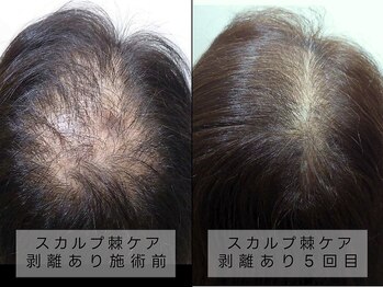 育肌美研 自由が丘サロン/頭皮ケア|ハーブピーリング