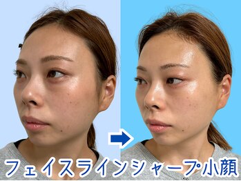 ナチュラルビューティーフェイス 横浜(NBF)/歪みが目立つ横顔に/横浜小顔