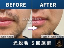 ロミオワックス 渋谷店(ROMEO Wax)/5回照射で鼻下がほぼ産毛に!ヒゲ