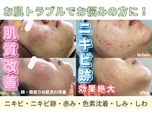 繰り返すニキビをケア！お肌トラブルでお悩みの方におすすめ！