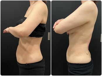 スパチャーレ(Spa ciare)/【トーンヌール】before&after