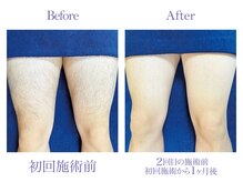ツルツル美肌脱毛/【メンズ脱毛】ひざ上脱毛