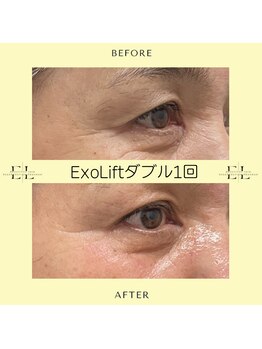 ジルフィー(GILFY)/目元のシワ/たるみ/くぼみ改善