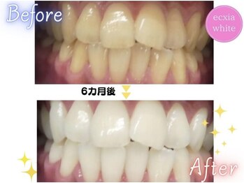 エクシアホワイトニング エミフルMASAKI店/セルフホワイトニング 6カ月後