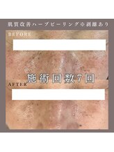 ベルミー(Bellmi)/肌質改善ハーブピーリング(顔)