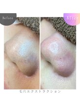 ラブ ザ テラス(Luv the TERRACE)/毛穴洗浄：ツヤ感ある毛穴レス！