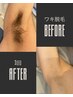 メンズSパーツ脱毛【美容ジェル保湿付】