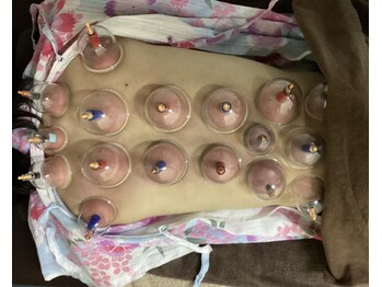 東洋足ツボ療法センター 仙川店/吸玉、カッピング