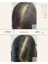 スカルプラボ(Scalp Lab)/moumitu症例6ヶ月