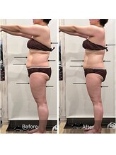 プリューム(PLUME)/ヒト幹細胞SLIM導入　１回施術