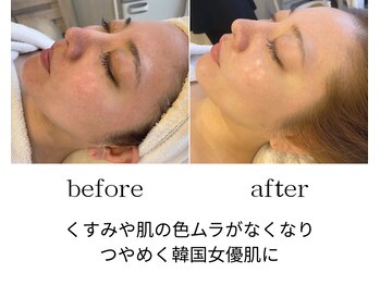 ビー ブルーム(B BLOOM)/【ハーブピーリング】肌質改善