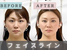 エルシンメトリー矯正院(ailesシンメトリー矯正院)/before＆after　ailes式小顔矯正