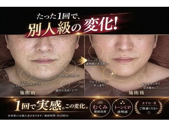 ティースキンサロンオキナワ(T-skin salon Okinawa)の写真/変化にびっくり！話題のマシン筋膜リリース&小顔リンパで一度で実感する小顔+美肌ケア！鏡を見たくなる顔へ