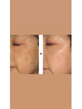 クラティス(CRATIS)/【ホームケアで改善◎】シミケア