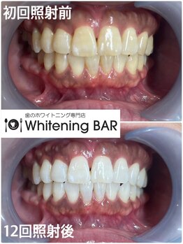ホワイトニングバー 仙台店/12回で理想の白さへ導きます