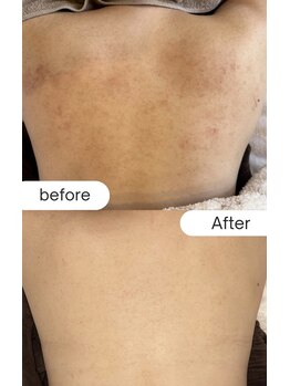 セレニテ(Serenite)/背中の症例写真