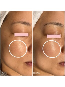 楚々(SOSO)/2回ご来店♪Before after