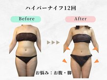 美容整体 ウェリナ 蟹江院/.【ダイエットbefore→after】