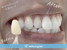 ホワイトニングカフェ 立川店(WhiteningCafe)/◎歯のホワイトニング施術写真◎