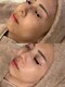 アマテラススキンラウンジ(Amatelas SKIN LOUNGE)の写真/◆Vリフト×LDMで叶える、リフトアップ&美ツヤ肌◆年齢を感じさせない美しさへ