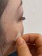 アーニャビューティー(Anya Beauty)の写真/シミケアの最新技術！新しいシミケアで、お顔のシミを整え明るい印象へ。SNSでも注目のシミケアを体験♪