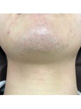 ナノハナ/鹿沼市本格全身脱毛ナノハナ