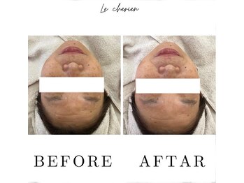 ルシェリア(Le cherien)/ピーリング