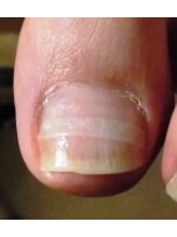 東京巻き爪センター 本院 麻布十番/プレート装着後の画像【東京】