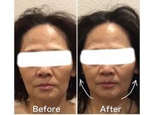 ブローチ 岡崎店(BROOCH)/最先端しわ・たるみメタジェクト