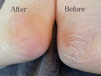 ネイル アトリエ コモード(nail atelier Comodo)/◆足裏角質除去