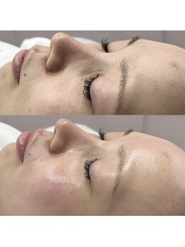 デイジー バイ アルテフィーチェ 梅田(daisy by artefice)/フェイスワックスでトーンアップ