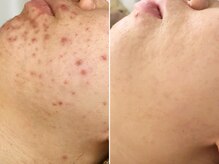 ハダイ(HADAY)/ニキビ改善｜ハーブピーリング