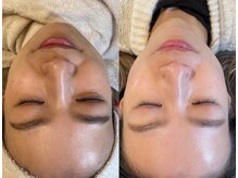 ルマ(Luma.)の雰囲気（角質の整理&驚きのスキンケア浸透率！！              ）