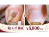 【陥入爪矯正】1爪＋全体のお爪切り込（3850円込）　￥8800　（初見料550円）