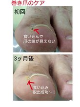 ドクターネイル爪革命 江戸川橋店/深爪注意。巻き爪になりますよ？