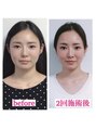 マナレア(Manalea) 小顔整顔2回のビフォーアフター