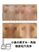 アンジェ(ange)/毛穴洗浄◎ハイドラフェイシャル