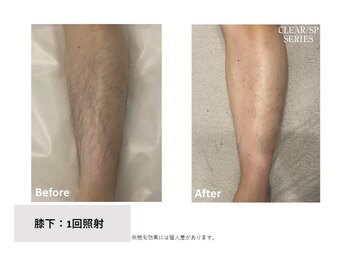 ラフ(LaFF)/膝下脱毛Before&After