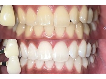 ペルレ(Perl)/ビフォーアフター