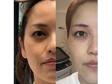 ソルテシュガーリング(SORTE sugaring)の雰囲気（【小顔ケア】テラボーラー！！シワたるみ、あなたのお悩み解決！）