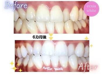 エクシアホワイトニング エミフルMASAKI店/セルフホワイトニング 6カ月後