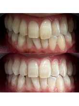 グレイスホワイトニング ヨコハマ(Grace Whitening Yokohama)/40分照射＋水素吸引